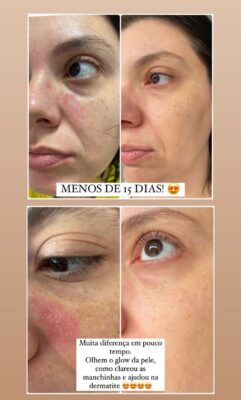 CONTROLAR O MELASMA
